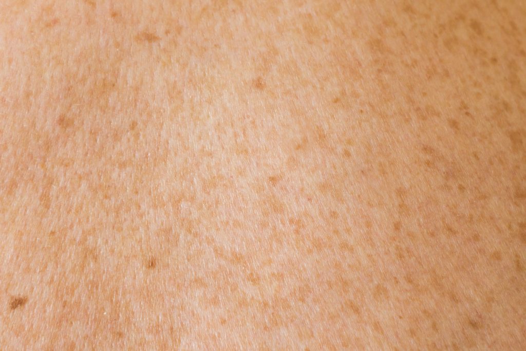 Image of fair skin with freckles